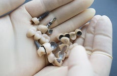 Dental implants | Golubovy/Shutterstock.com